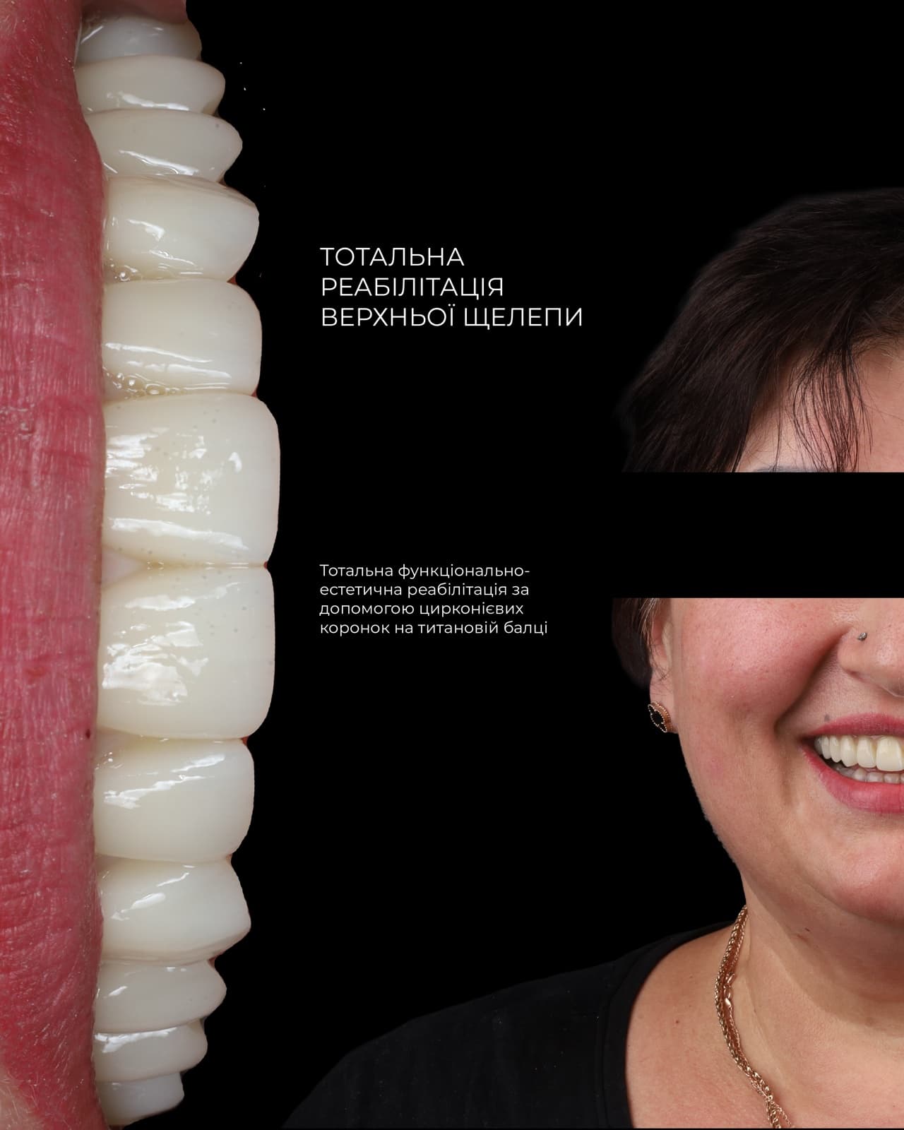 Тотальна реабілітація верхньої щелепи