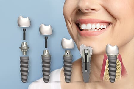 Набряк після імплантації зубів — нормальна реакція після операції