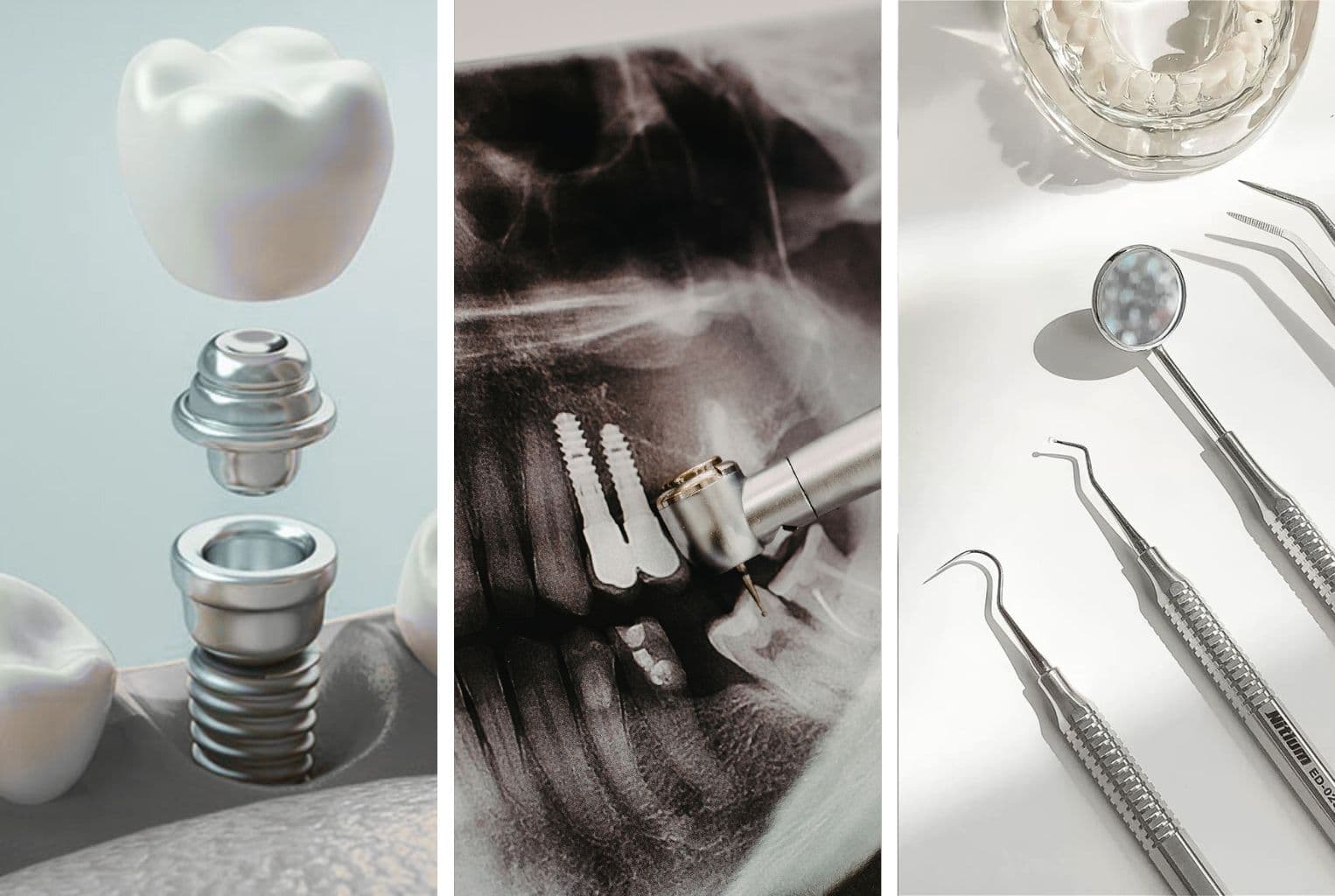 Діагностика перед імплантацією зубів — рентген та планування лікування