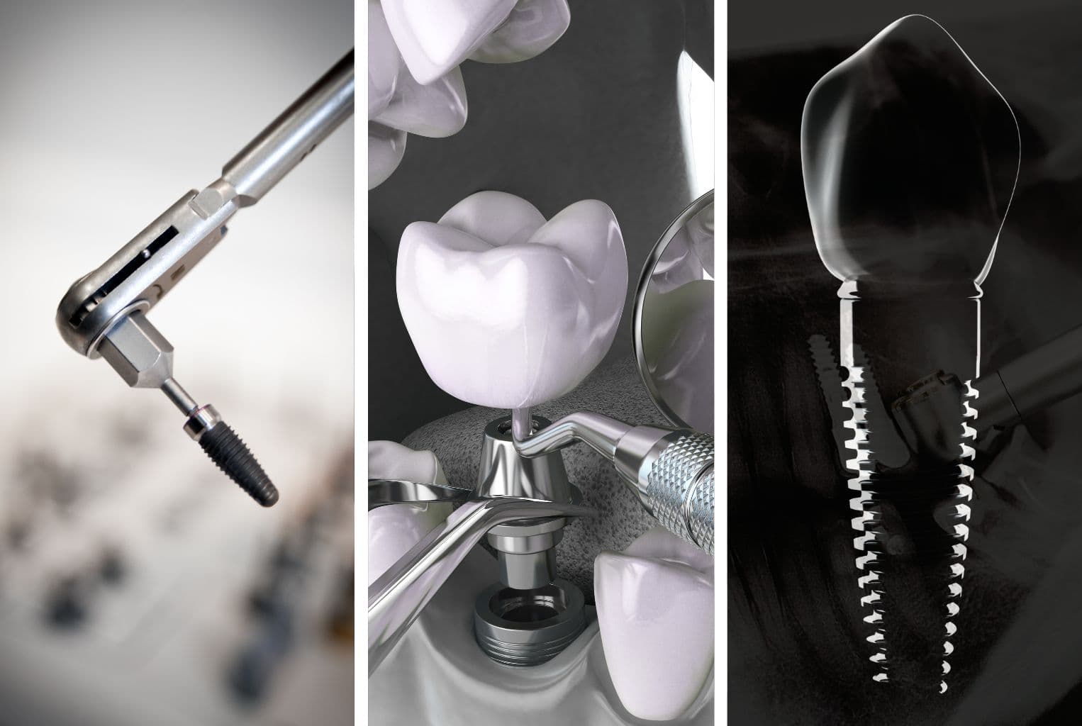 Імплантація зубів у Львові — сучасне обладнання та титановий імплант