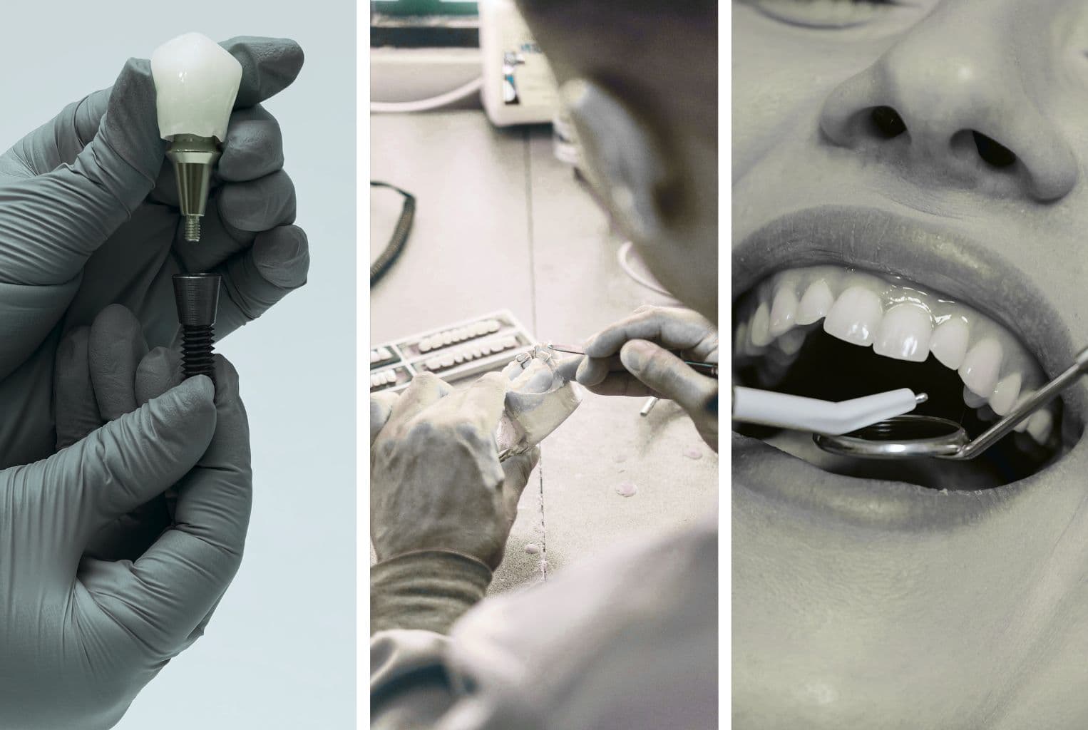 Діагностика та планування імплантації зубів