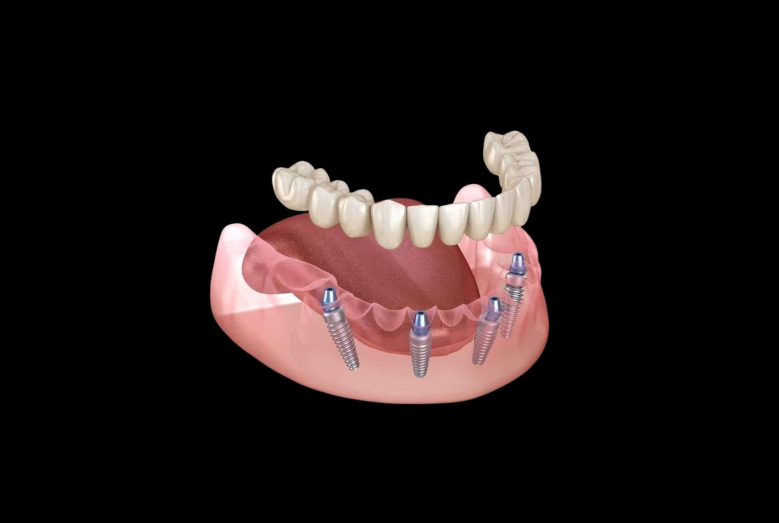 All-on-4 імплантація — повне відновлення зубів на чотирьох імплантах