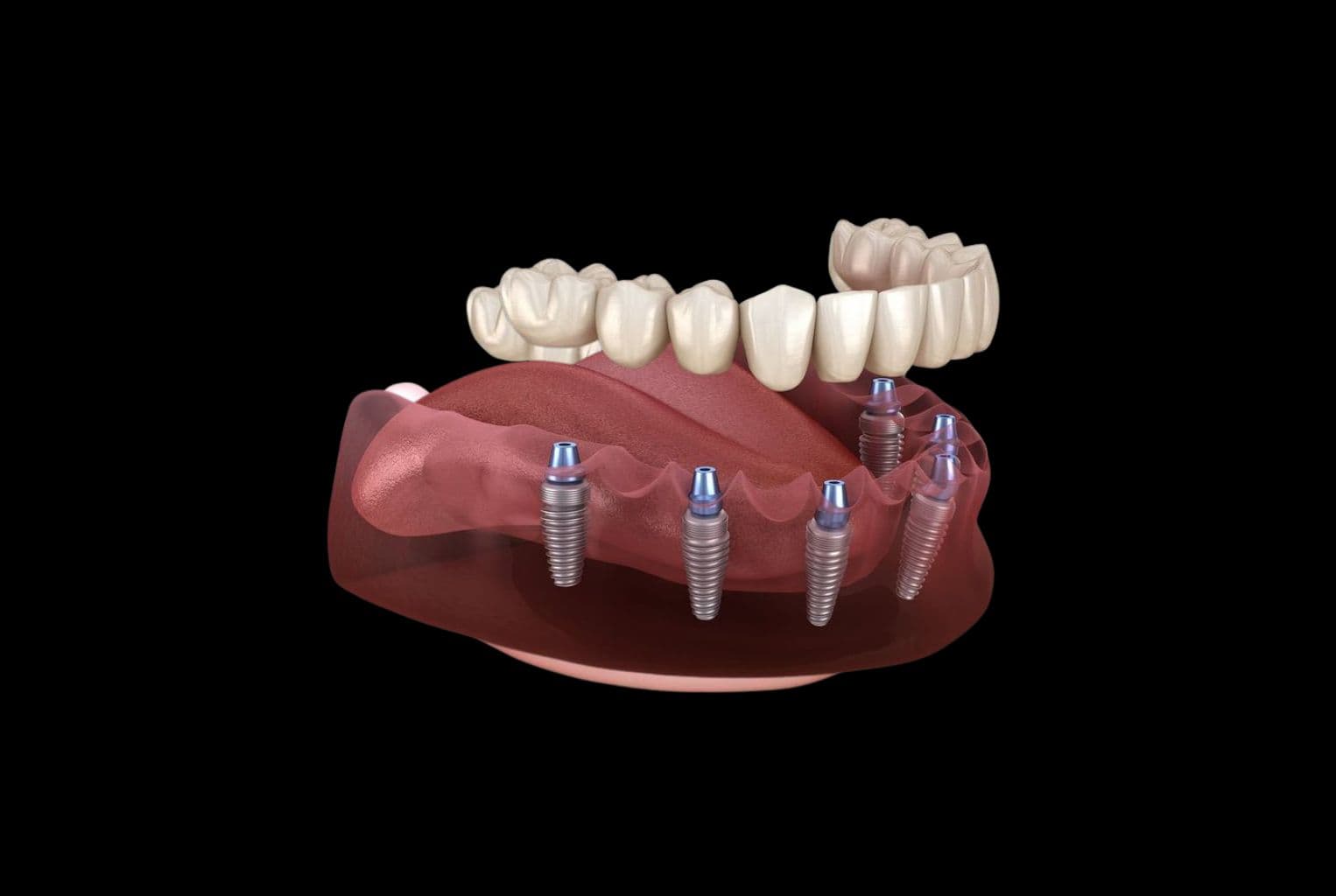 All-on-6 імплантація — повне відновлення зубів на шести імплантах