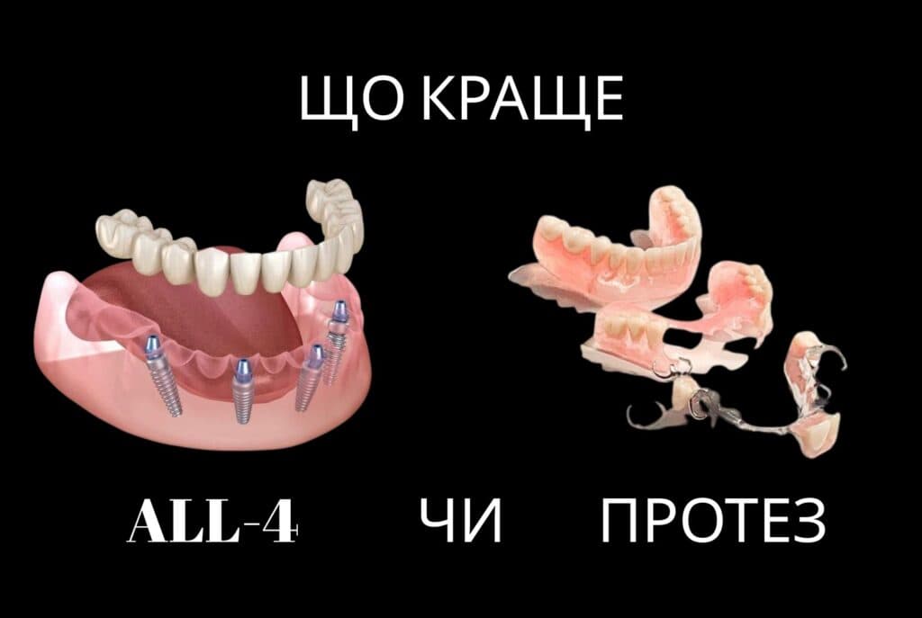 Порівняння імплантації All-on-4 та знімного зубного протеза