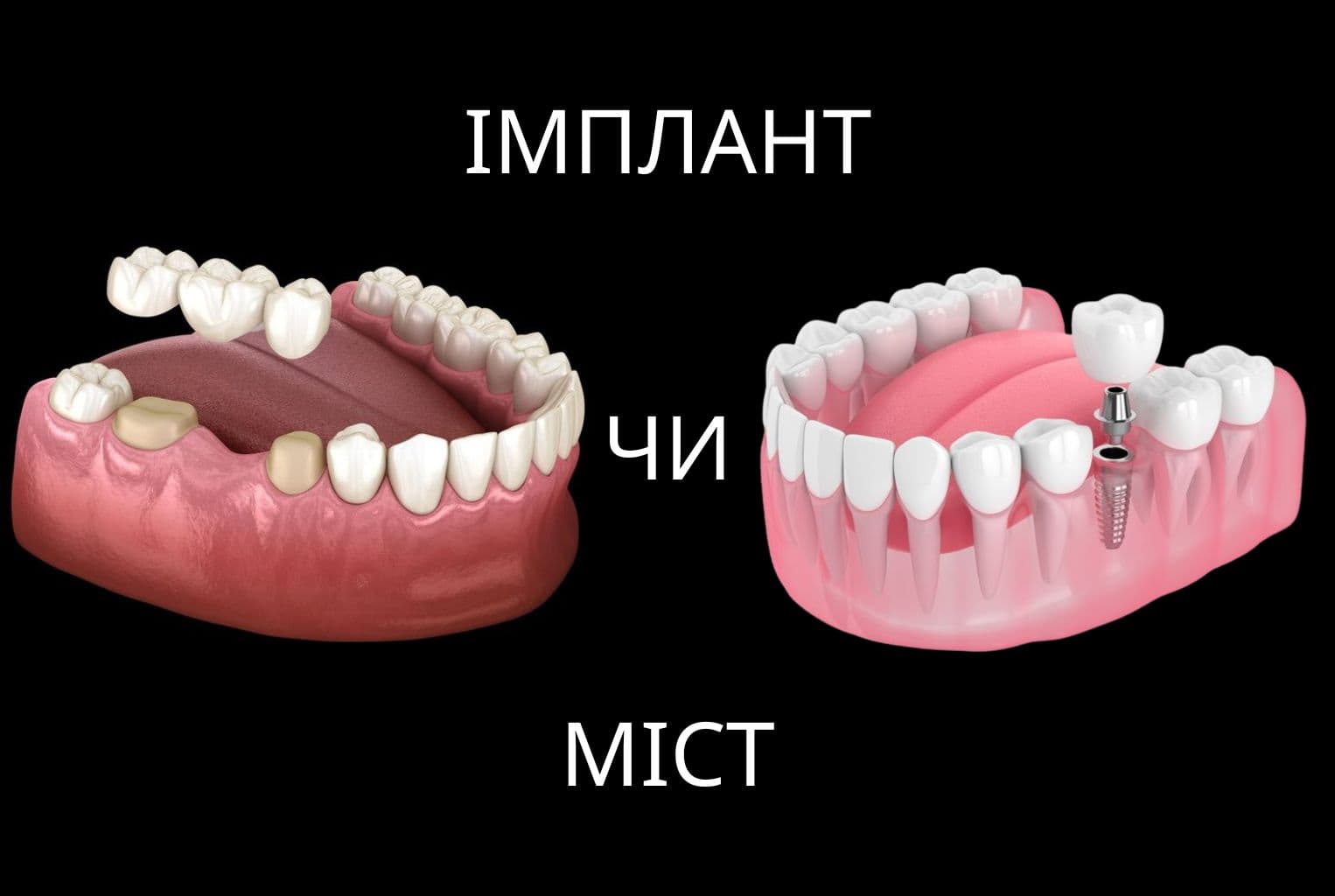 Що краще: імплант чи міст — порівняння способів відновлення зуба