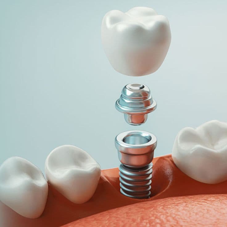 Одномоментна імплантація зуба — встановлення імпланта одразу після видалення зуба